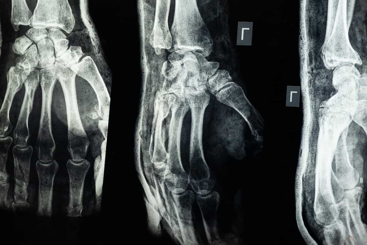 hand X-ray after a personal injury in Peachtree Corners, GA