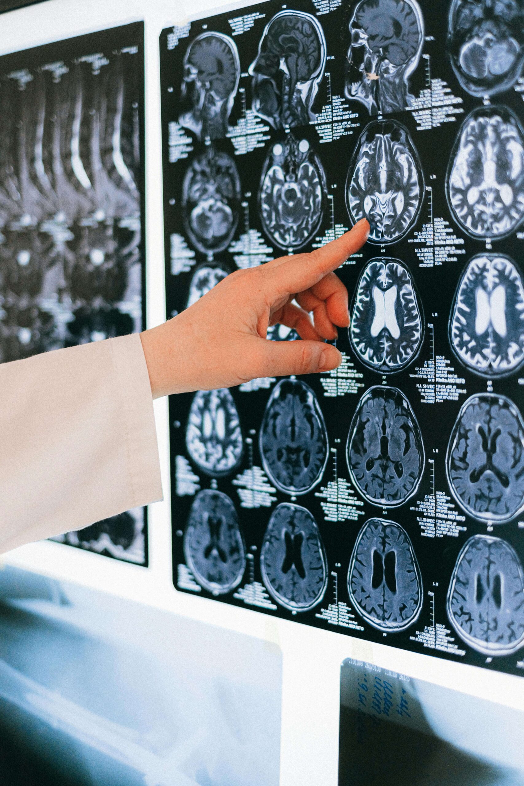 Peachtree Corners traumatic brain injury lawyer - brain injury scan